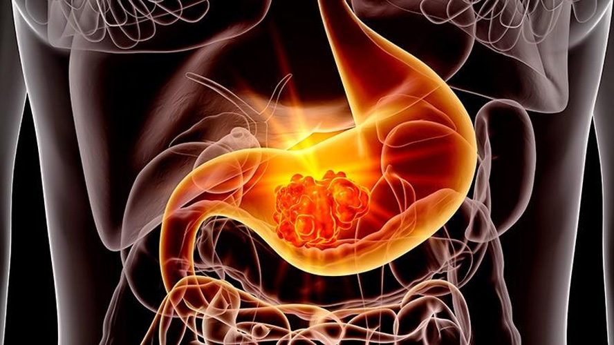 Gastric Cancer