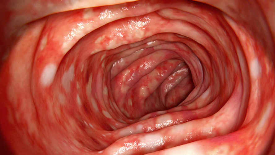 Moderate to Severe Crohn's Disease