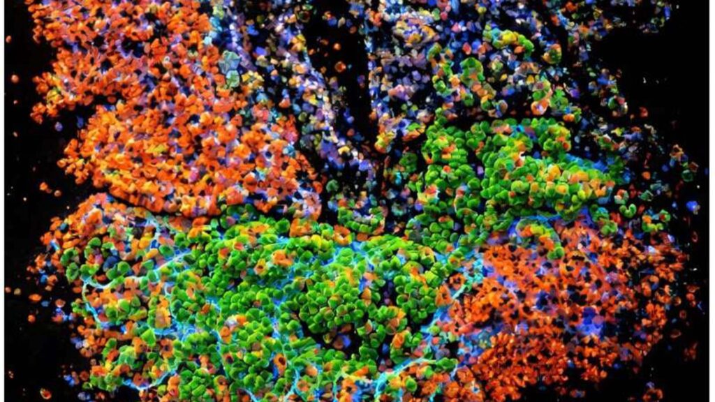 Discovery illuminates how inflammatory bowel disease promotes colorectal cancer (Medical Xpress)